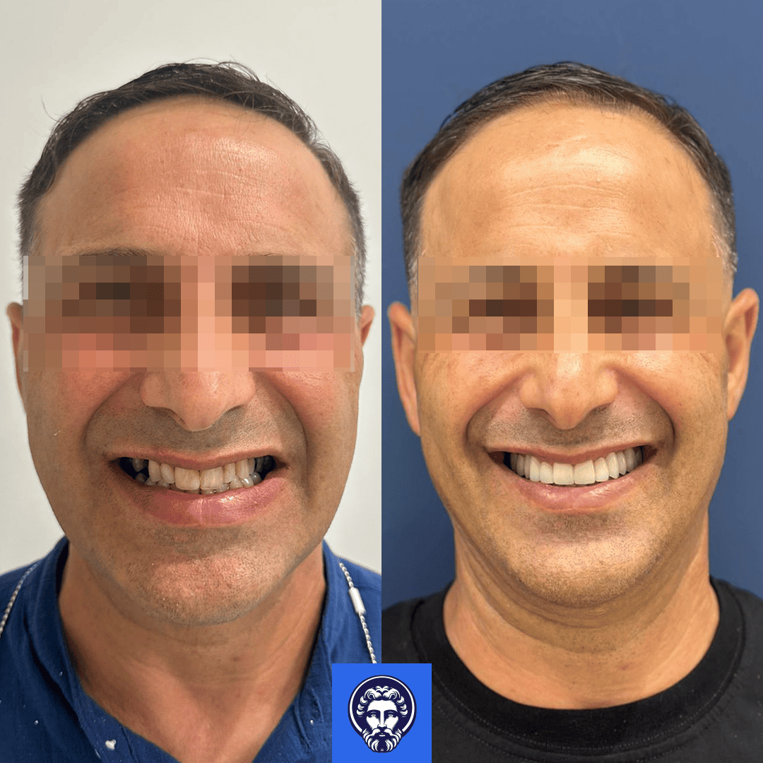 andrea cocola before_after