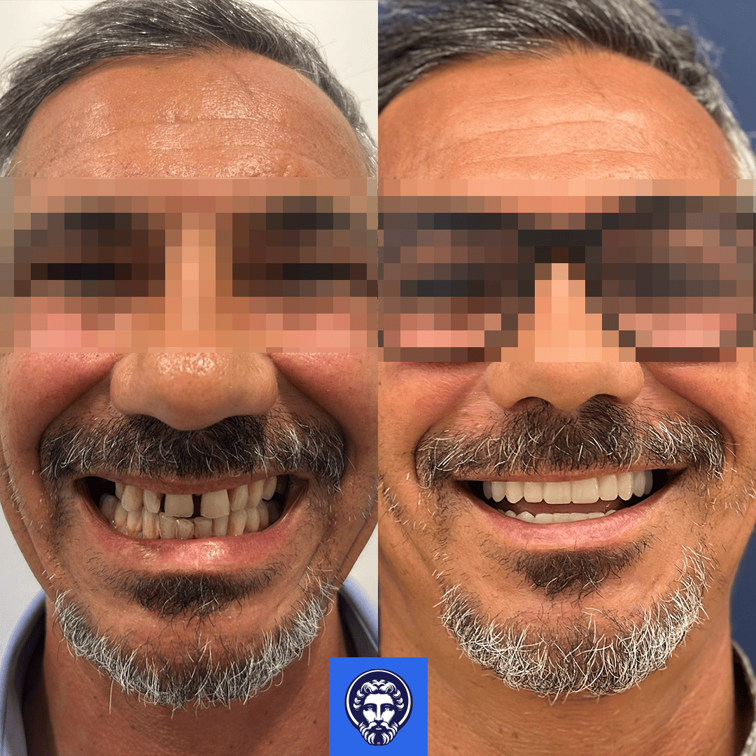 massimo marino before_after
