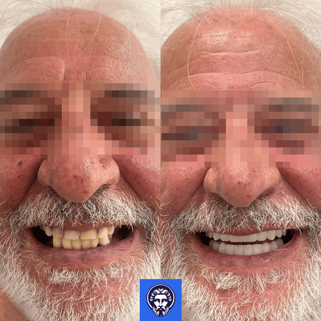 nino before_after