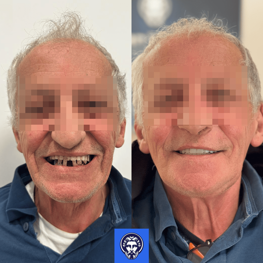 vincenzo gatta before_after